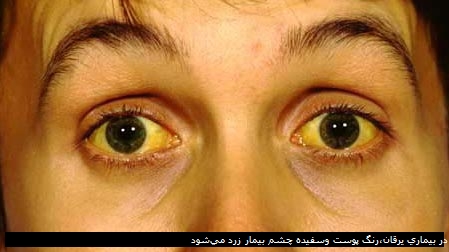 در بیماری یرقان،‌رنگ پوست وسفیده چشم بیمار زرد می‌شود