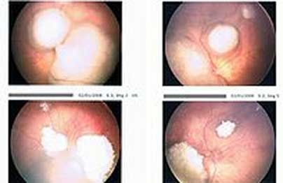 چشم بیمار رتینو بلاستومی، قبل و بعد از درمان