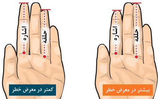 مطالعه طول انگشتان دست برای بررسی خطر ابتلا به سرطان پروستات 