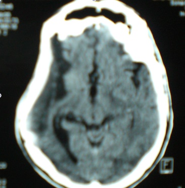 stroke۲