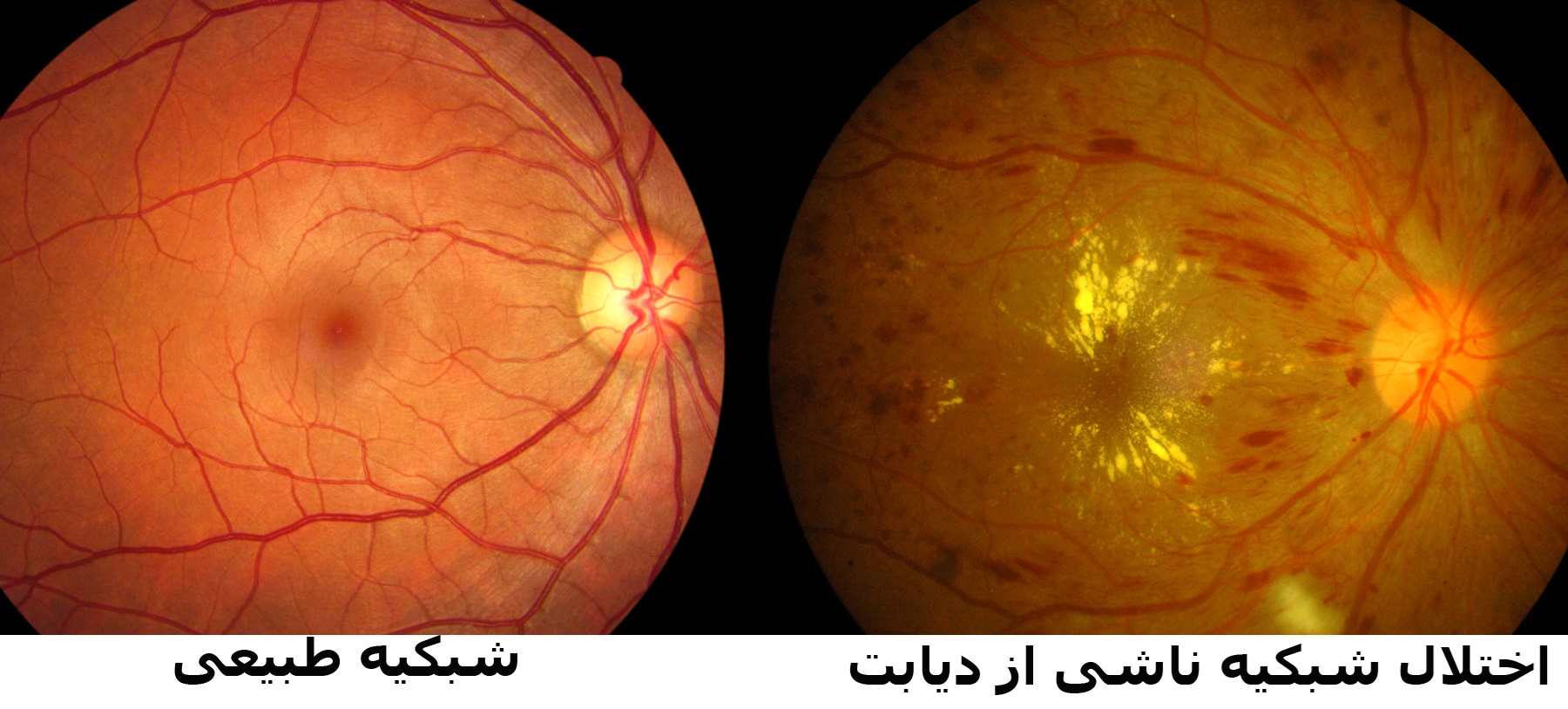 نکته بهداشتی: بیماری چشمی دیابت