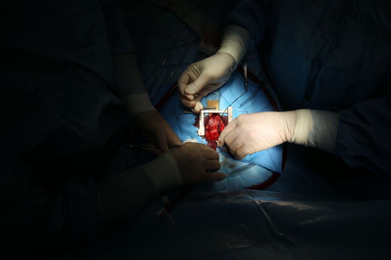  جراحی قلب کودک ۱۵ ماهه در بیمارستان شهید مدرس 