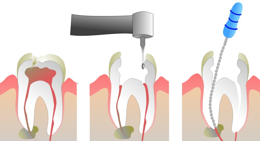root canal ۲