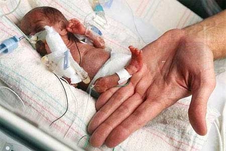 ریزترین نوزادان جهان به سلامت بزرگ شدند