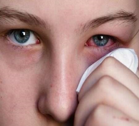 توصیه‌های بهداشتی برای محافظت از چشم‌ها در هنگام آلودگی هوا