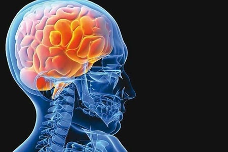 آشنایی با راهکارهای ساده برای پیشگیری از سکته مغزی