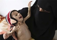 سازمان ملل: یمن با فاجعه انسانی روبه رو است