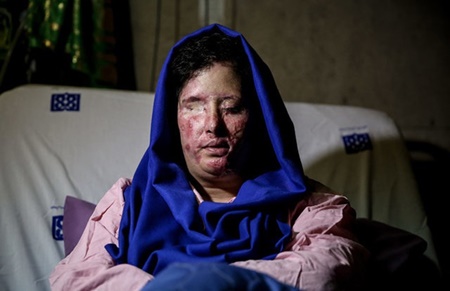 درخواست یکی از قربانیان اسیدپاشی در اصفهان از ظریف و هاشمی