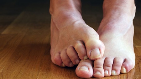سندرم پای بی قرار چیست؟ | درمان پای بی قرار چیست؟