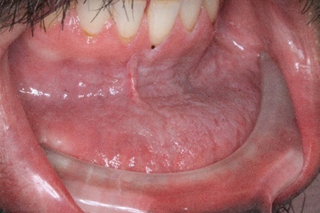 نشانه‌های سرطان دهان