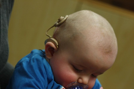 نکته بهداشتی: ایمپلنت حلزون شنوایی