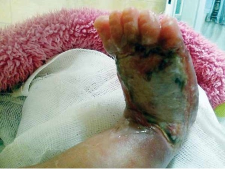 تأیید سهل‌انگاری پزشکان در سوزاندن پای نوزاد چند روزه