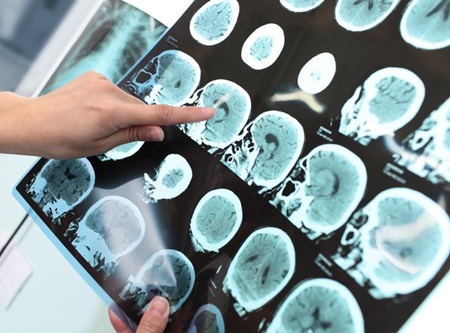 مرکز مراقبت‌های ویژه سکته‌های حاد مغزی در بیمارستان‌ها تعریف می‌شود