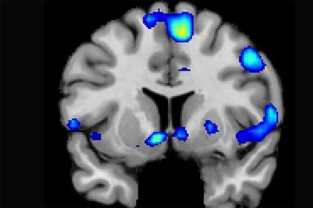 تشخیص محل HIV در مغز با اسکن MRI