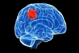 تاثیر استرس در بروز تومورمغزی | سردردها را جدی بگیرید