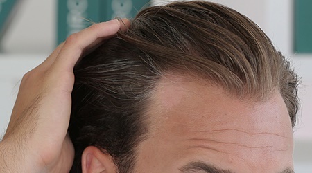 ضعف سلامت مو با چه بیماری‌هایی ارتباط دارد؟