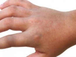 ورم دست را جدی بگیرید | زمان طلایی درمان آسیب دست 