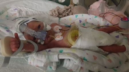 نوزادی که ۲۲ دقیقه قلبش ایستاده بود به یک‌سالگی رسید
