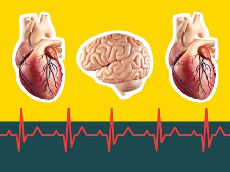 افزایش خطر سکته مغزی پس از حمله قلبی