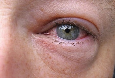 نکته بهداشتی: التهاب ملتحمه چشم