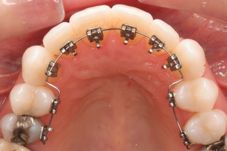 نکته بهداشتی: چرا دندان‌ها نامرتب می‌شوند