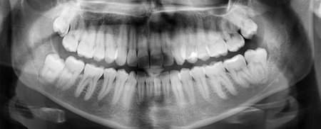 ابداع درمانی ساده برای رفع پوسیدگی خفیف دندان