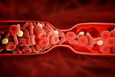 عوامل تاثیرگذار بر افزایش خطر لخته شدن خون را بشناسید