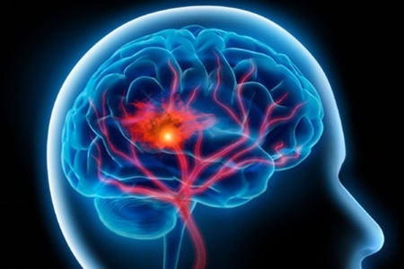 شایع‌ترین علت بروز سکته مغزی چیست؟