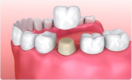 نکته بهداشتی: کاربردهای روکش دندان