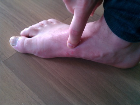 نکته بهداشتی: پیشگیری از تاول پا
