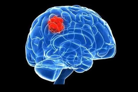 تومور مغزی سیستم ایمنی را تغییر می‌دهد