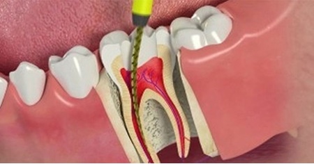 آشنایی با عمل کانال ریشه دندان یا عصب‌کِشی 