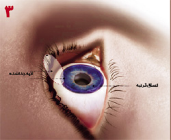  پزشک لایه بریده شده را از روی چشم برمی‌دارد. این لایه البته به طور کامل از سطح چشم جدا نشده و به صورت یک لولا به آن متصل است. به این ترتیب پزشک به قسمت‌های عمیق‌تر قرنیه دسترسی پیدا می‌کند. 
