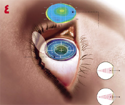  نقشه‌ای که قبلا از وضعیت چشم بیمار تهیه شده، به دستگاه لیزر داده شده و بر روی چشم بیمار قفل می‌شود. 