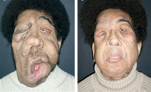 بیمار مبتلا به نوروفیبروماتوز صورت قبل و بعد از پیوند