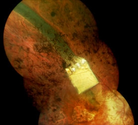 retinal implant
