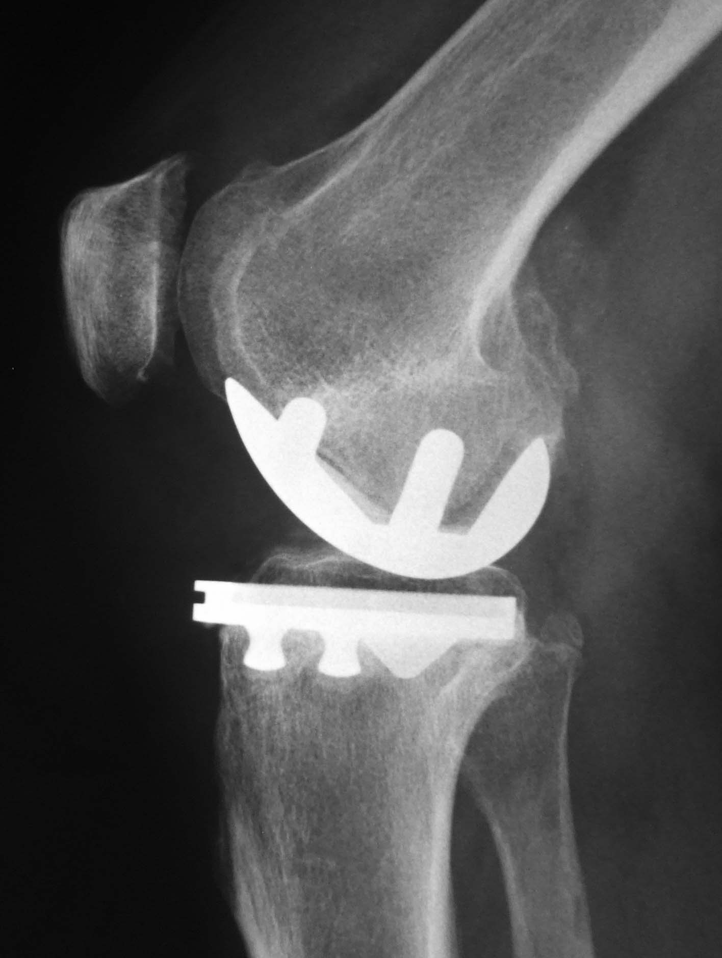 knee replacement