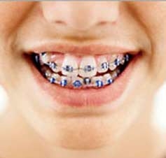 65 درصد ازافراد دارای ناهنجاری های فکی - دندانی هستند