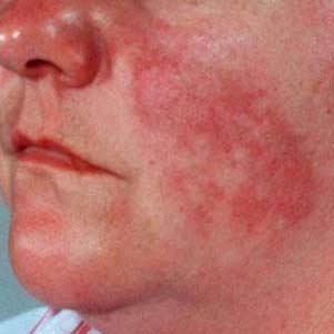 بیماری لوپوس، پوست و مفاصل را همزمان تهدید می‌کند