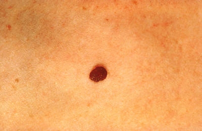 normal-mole