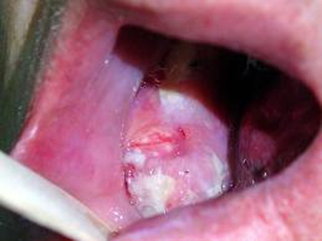 مفاهیم: سرطان دهان چیست؟
