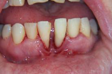 مفاهیم: سرطان دهان چیست؟