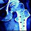 داربستی مقاوم برای ترمیم استخوان با نانو فناوری در کشور تولید