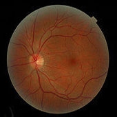 احیای شبکیه چشم با هم‌جوشی سلولی