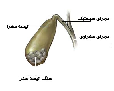 برای جلوگیری از سنگ کیسه صفرا چی بخوریم؟