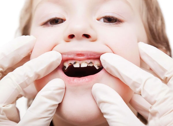 پوسیدگی دندان-کودکان