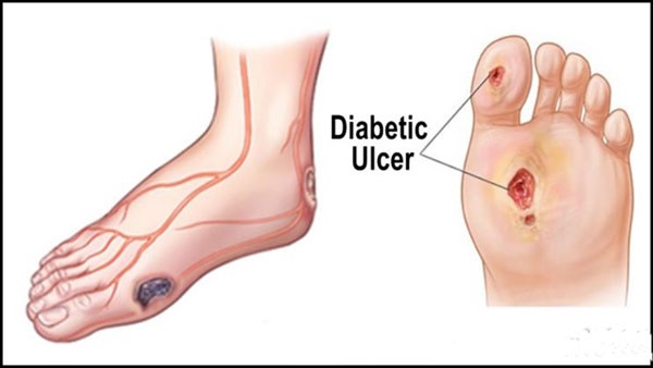 راه‌های پیشگیری از زخم پای دیابتی/بررسی روزانه سلامت پا