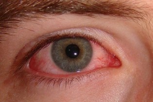 لکه های  قرمز داخل چشم
