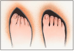 نکته بهداشتی: آسیب‌های کفش تنگ
