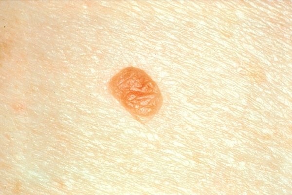 سرطان پوست نشانه خطر ابتلا به سرطان‌های دیگر است